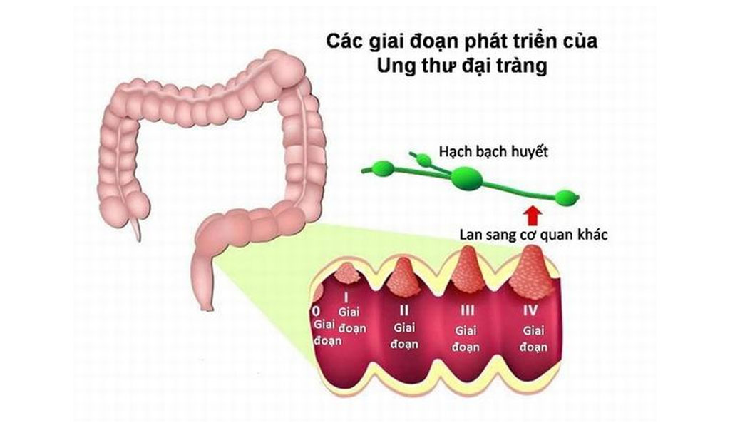 Các giai đoạn ung thư đại trực tràng