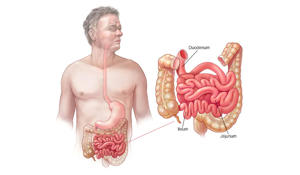 Các yếu tố nguy cơ đối với ung thư ruột non (ung thư biểu mô tuyến)