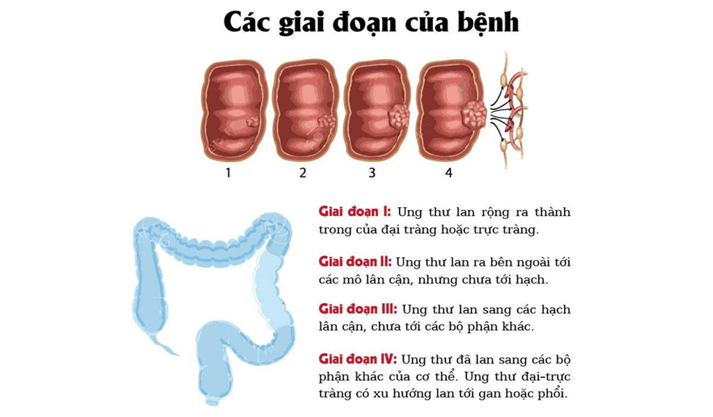 Điều trị ung thư trực tràng theo giai đoạn