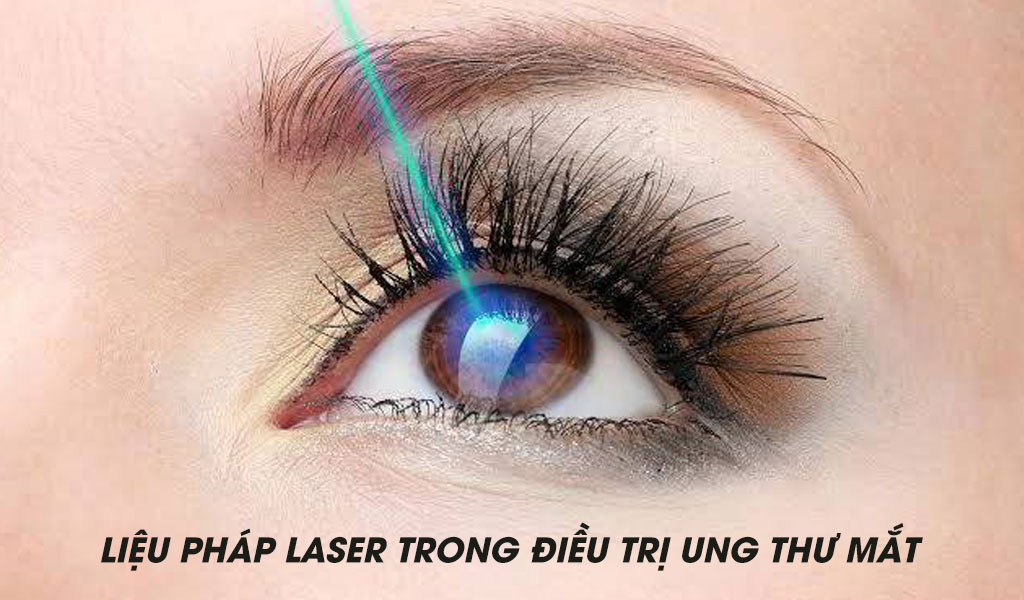 Liệu pháp Laser trong điều trị ung thư mắt