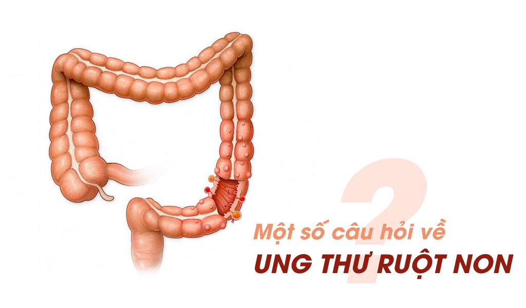 Một số câu hỏi về ung thư ruột non