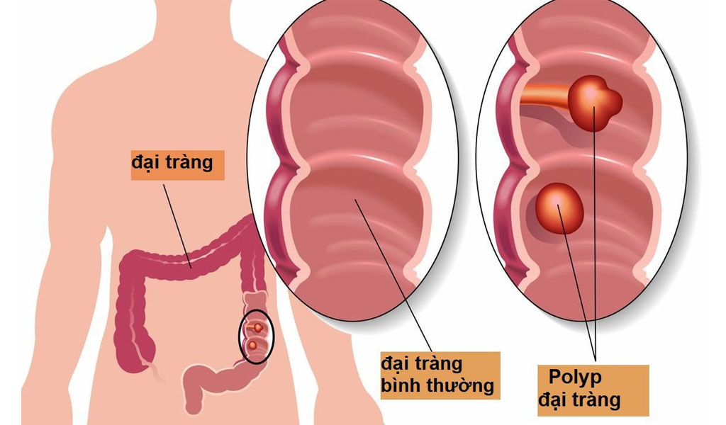 Nguyên nhân gây ung thư đại trực tràng