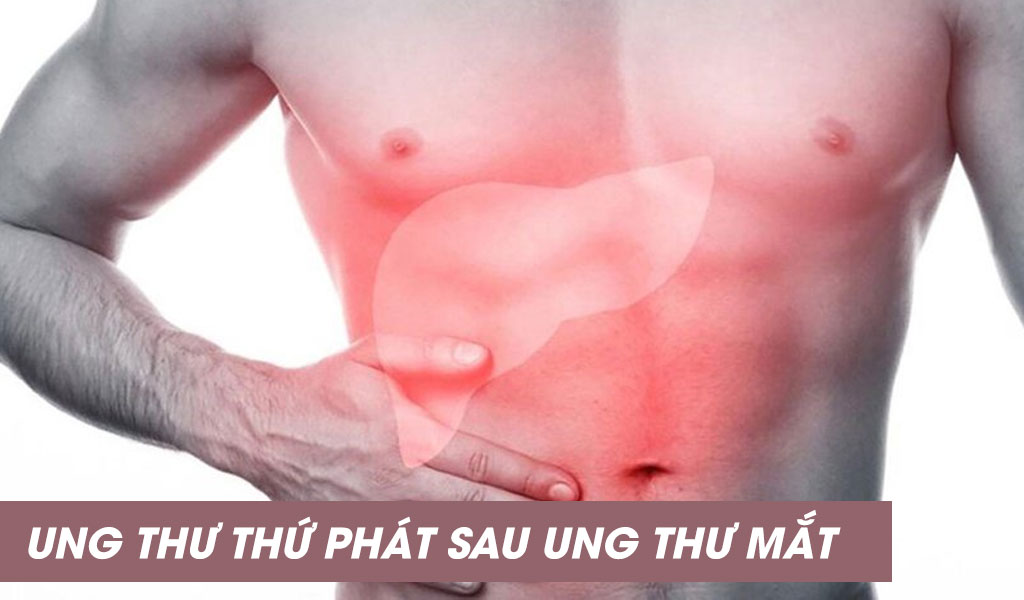 Ung thư thứ phát sau ung thư mắt