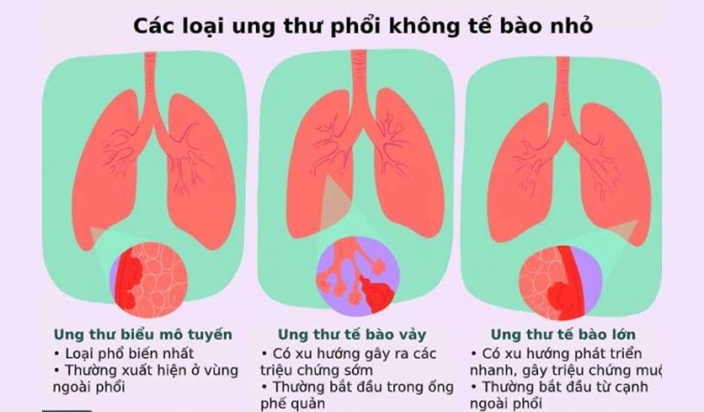 Các giai đoạn ung thư phổi không tế bào nhỏ