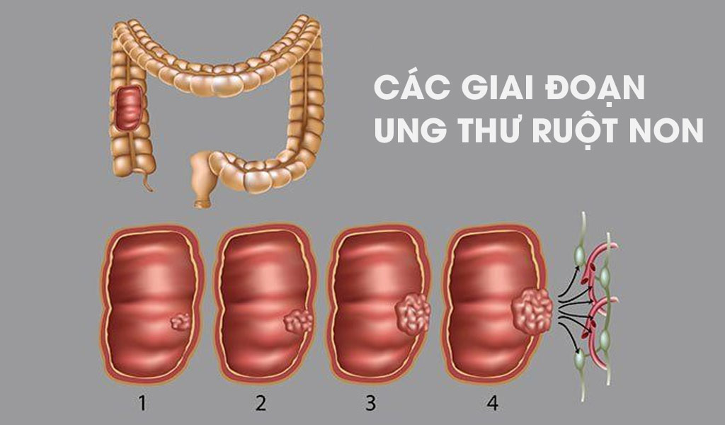  Các giai đoạn ung thư ruột non (ung thư biểu mô tuyến)