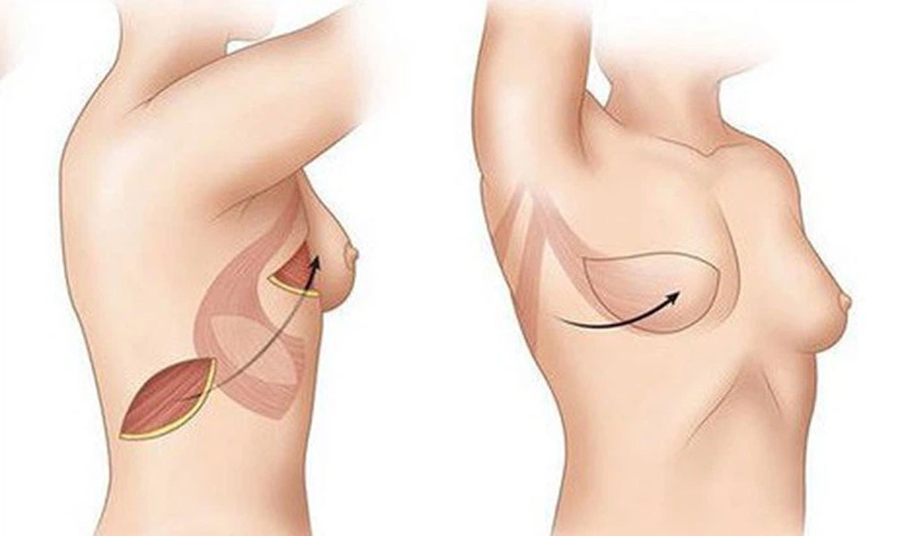 Các giải pháp thay thế phẫu thuật tái tạo vú