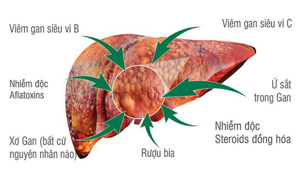 Các yếu tố nguy cơ ung thư gan