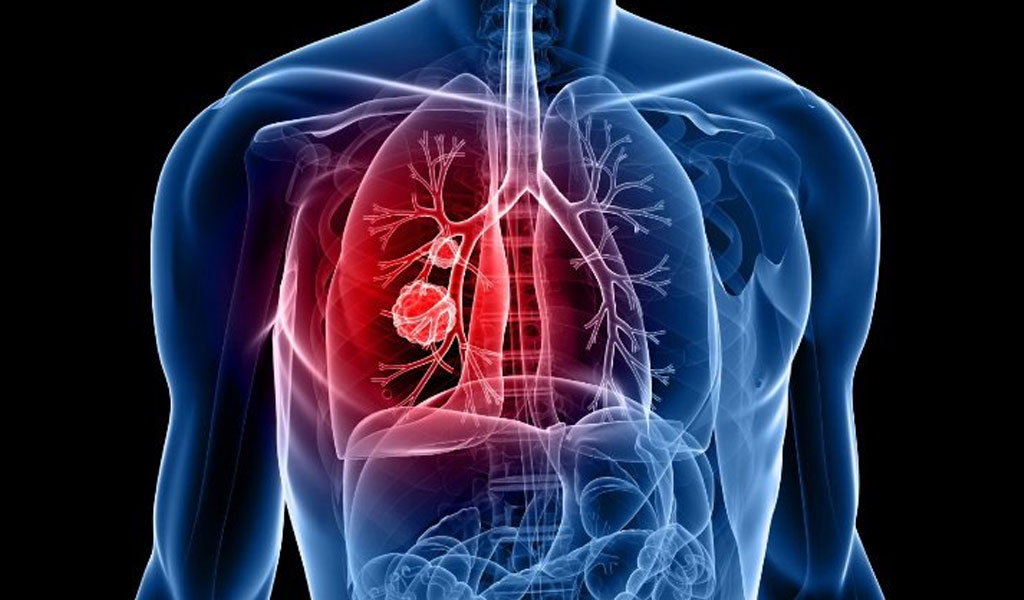 Chuyên gia sức khỏe liên quan đến nhóm điều trị ung thư phổi không tế bào nhỏ
