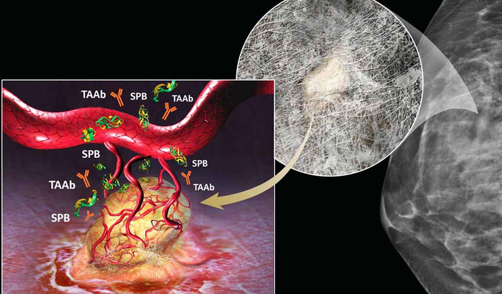 Điều trị ung thư vú bộ ba âm tính (Triple-negative breast cancers - TNBC)