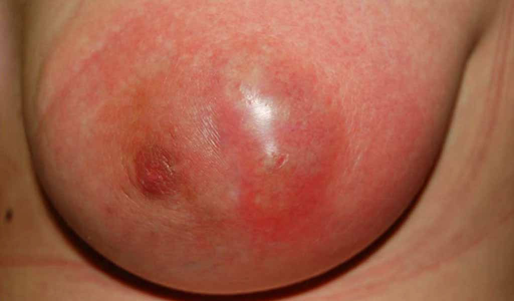 Điều trị ung thư vú dạng viêm (Inflammatory Breast Cancer - IBC)
