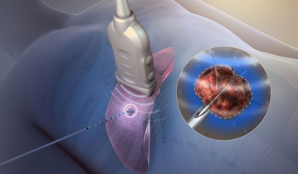 Đốt sóng cao tần (RFA) cho ung thư phổi không tế bào nhỏ