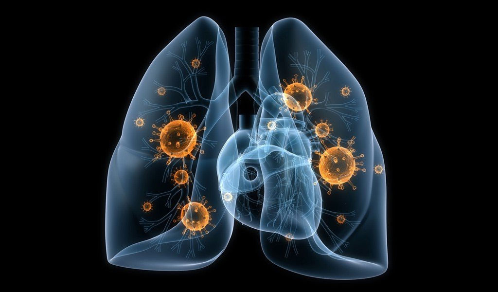 Giai đoạn ung thư phổi tế bào nhỏ