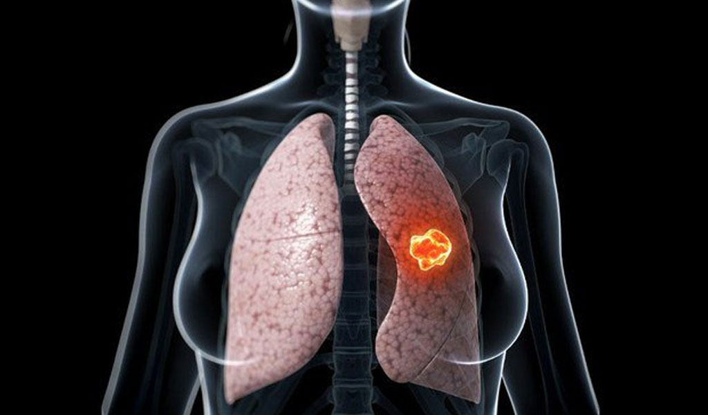 Nếu bạn bị ung thư phổi không tế bào nhỏ