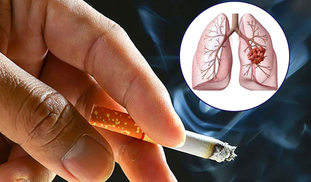 Nguyên nhân gây ung thư phổi?