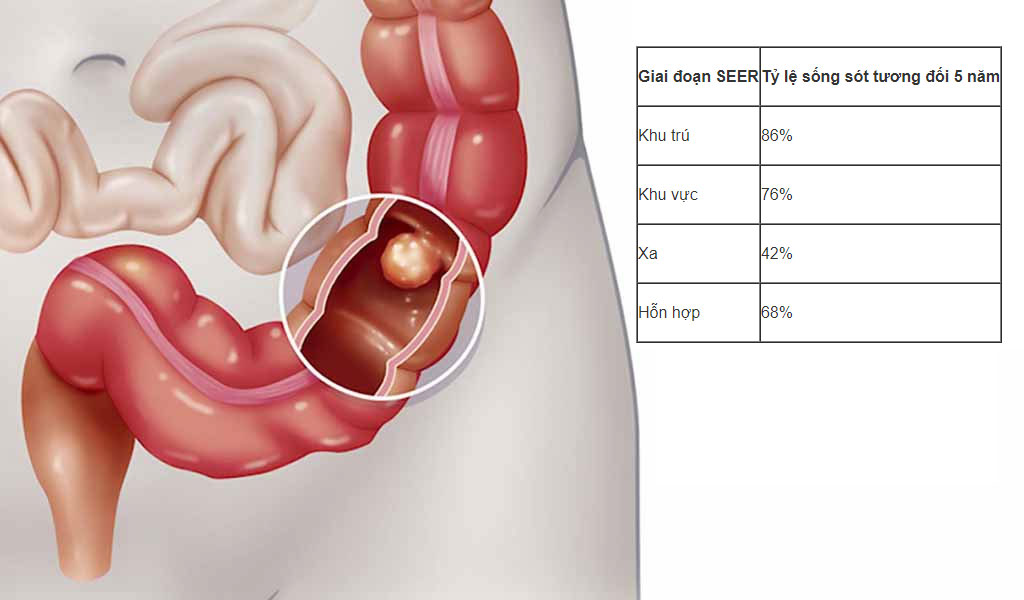 Tỷ lệ sống sót của ung thư ruột non (ung thư biểu mô tuyến)