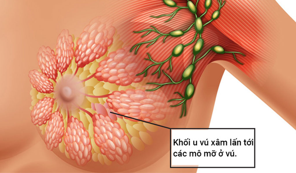 U mạch máu ác tính (Angiosarcoma) ở vú