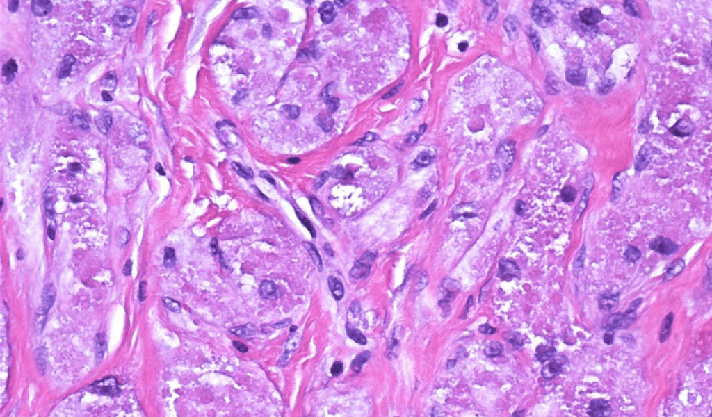 U vú tế bào hạt (Granular cell tumors)