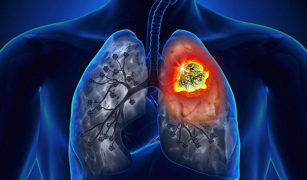 Ung thư phổi là gì?