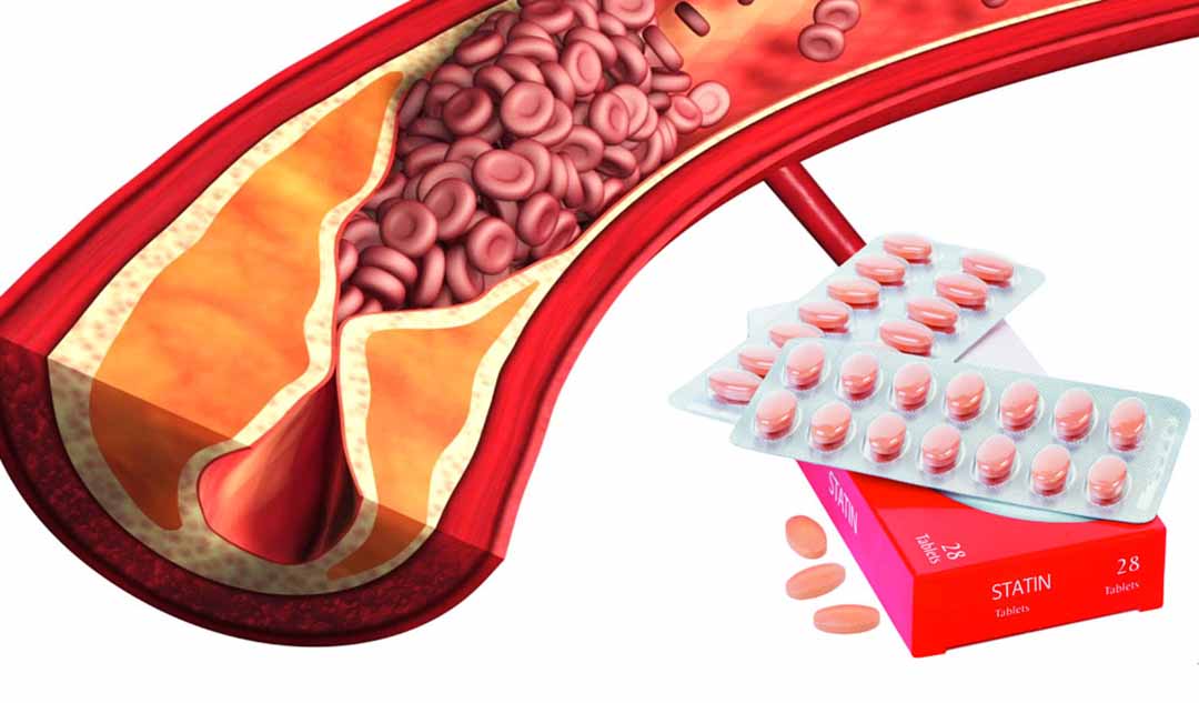 Bạn có thể dùng statin để đảo ngược hoàn toàn quá trình xơ vữa động mạch không?