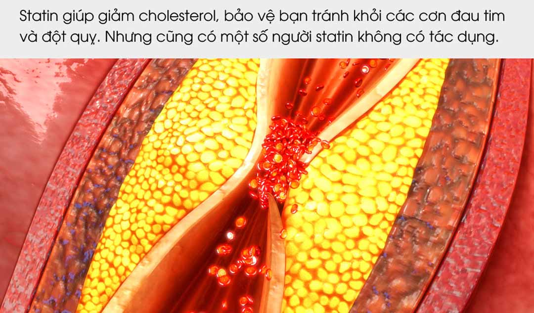 Có phải statin luôn có tác dụng trong việc giảm cholesterol?