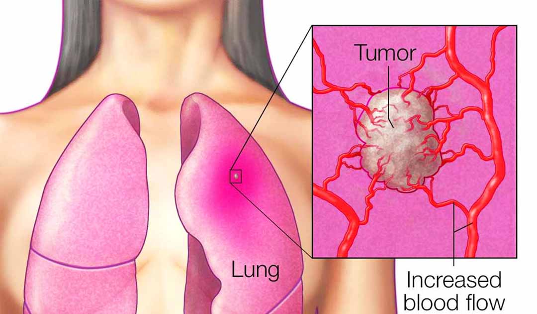 Khối u phổi bắt đầu như thế nào?