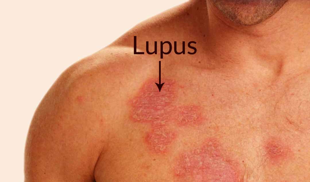 Nguyên nhân gây bệnh Lupus?