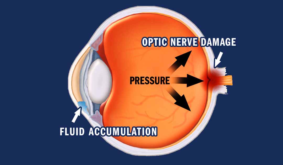 Nguyên nhân gây tăng áp lực cao trong mắt là gì?