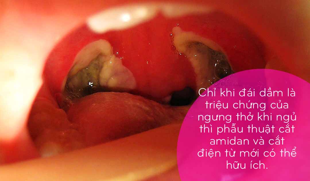 Cắt amidan có thể giúp loại bỏ đái dầm hay không?  