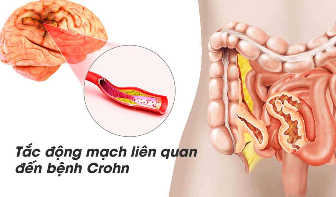 Bạn có thể kiểm tra khả năng bị viêm hoặc tắc động mạch liên quan đến bệnh Crohn bằng cách nào?