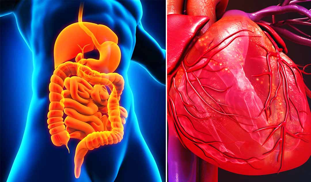 Bệnh Crohn là gì và có liên quan đến tim mạch như thế nào?