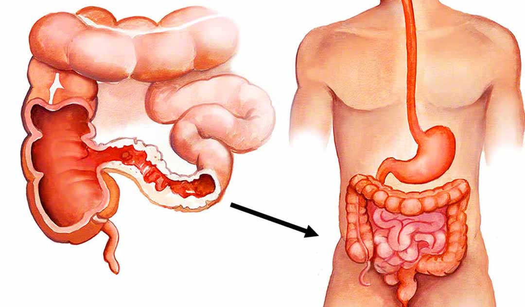 Bệnh Crohn thường ảnh hưởng đến những bộ phận nào của cơ thể?