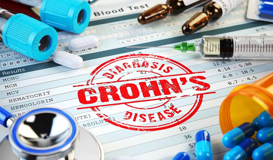 Bệnh nhân có thể làm gì nếu thuốc không thể kiểm soát được bệnh Crohn?