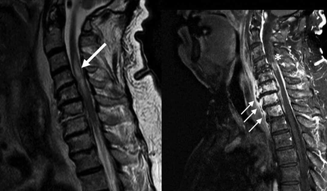 Cách tốt nhất để chữa bệnh Viêm não tủy lan tỏa cấp là gì?