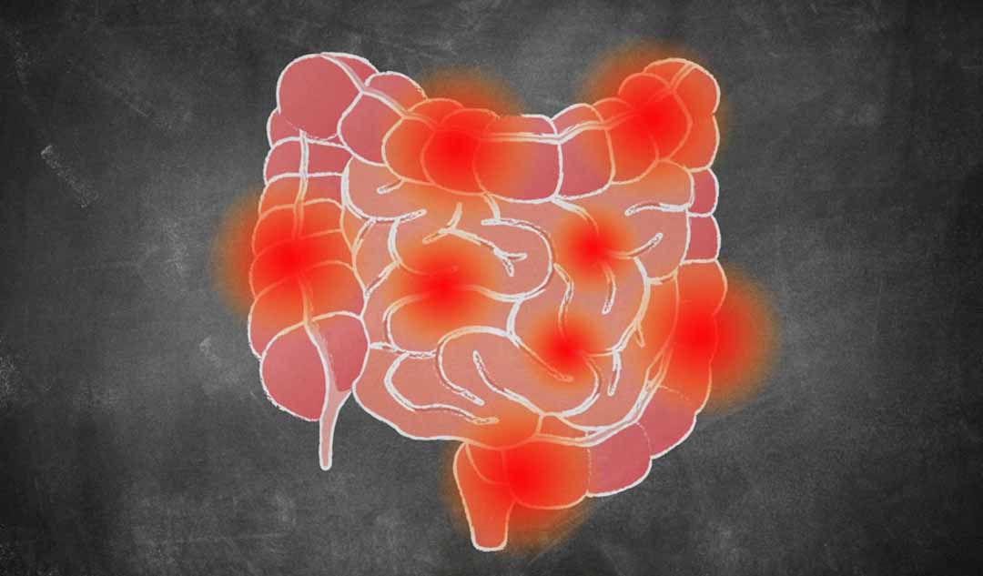 Mối liên hệ giữa bệnh Crohn và tim của bạn là gì?