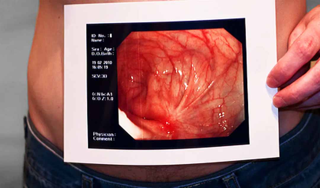 Những biến chứng nào của bệnh Crohn có thể yêu cầu phẫu thuật?