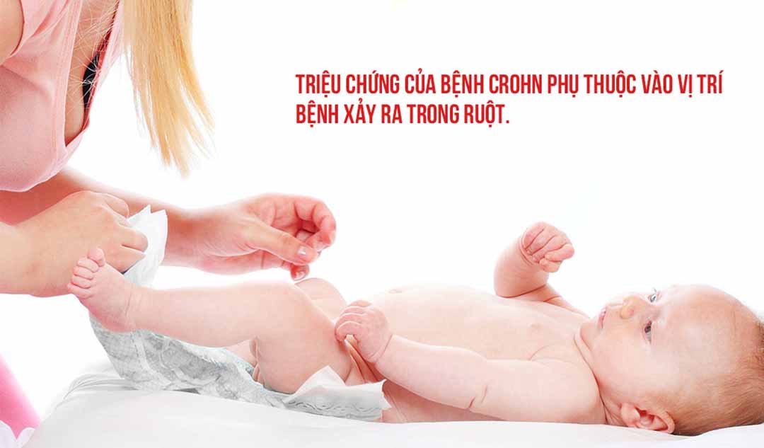 Những triệu chứng bệnh Crohn ở trẻ em và trẻ vị thành niên là gì?