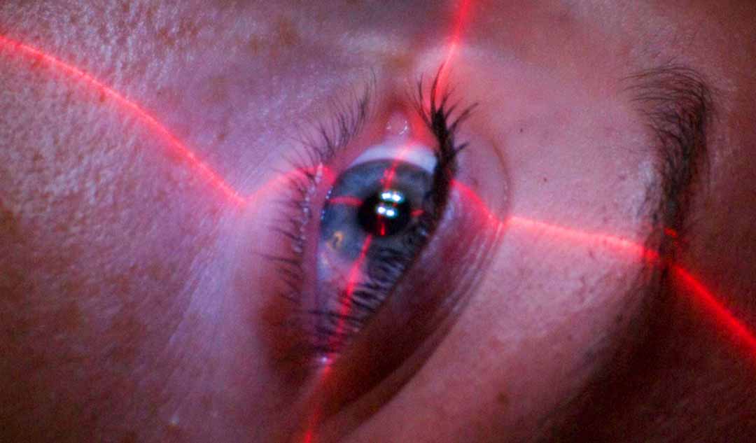 Bạn nên chuẩn bị cho việc cắt gọt giác mạc bằng tia laser vào ngày phẫu thuật như thế nào?