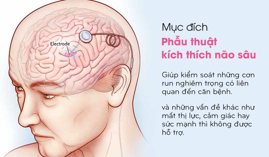 Làm thế nào mà phẫu thuật Kích thích não sâu giúp ích cho bệnh Đa xơ cứng?