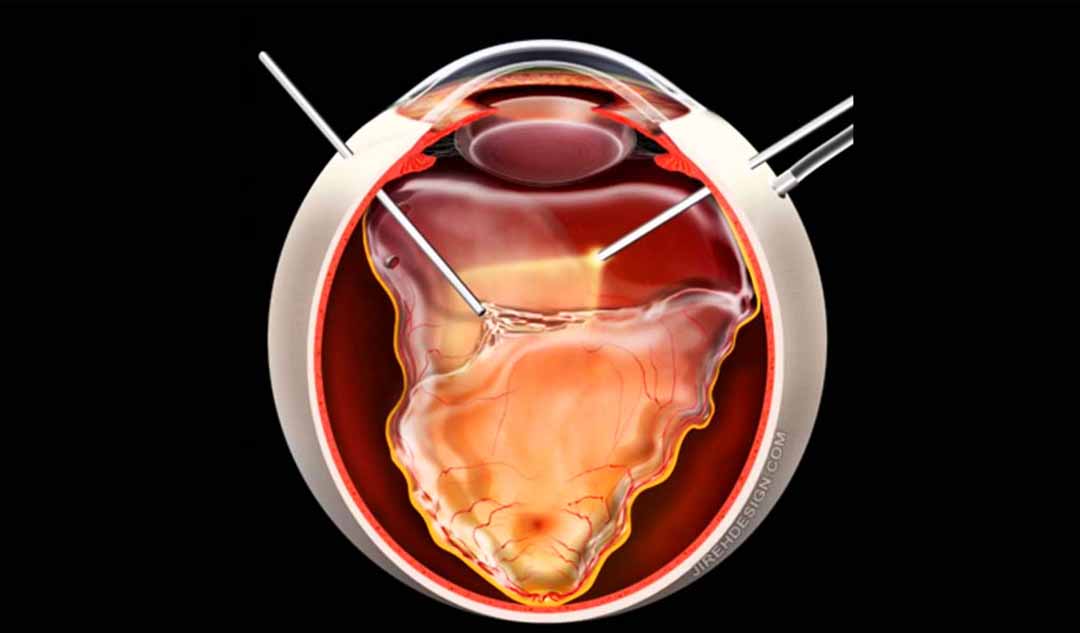  Những loại phẫu thuật nào có thể chữa rách võng mạc?