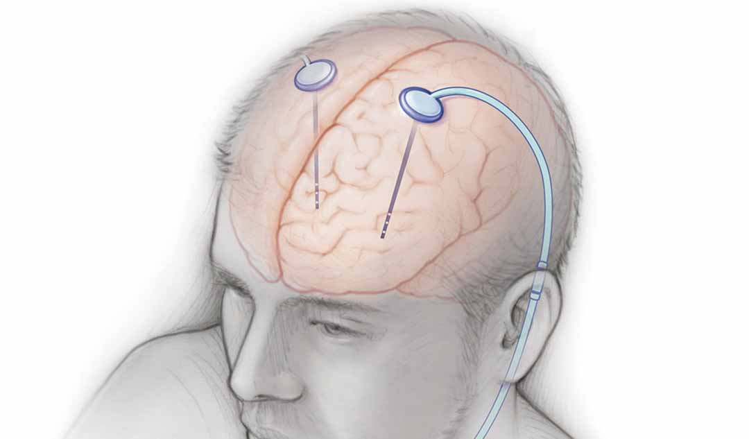 Những lợi ích khi sử dụng phương pháp kích thích não sâu là gì ?