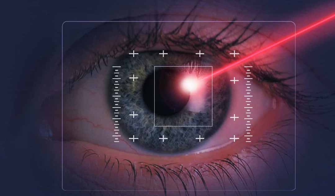  Phẫu thuật EPI-LASIK là gì?