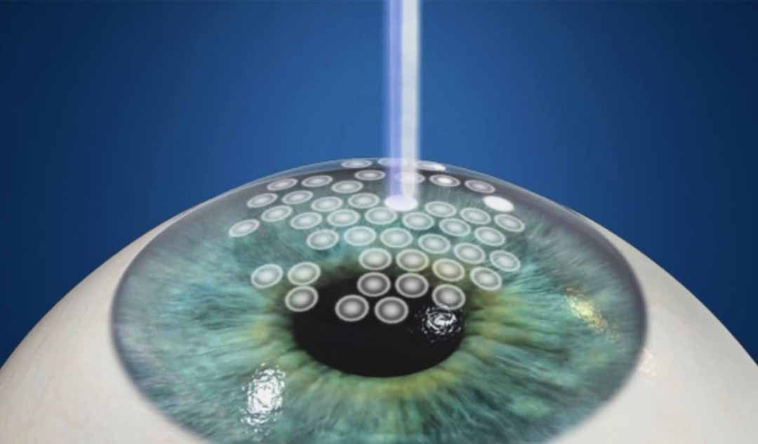 Phương pháp cắt gọt giác mạc bằng tia laser (Photorefractive Keratectomy - PRK) là gì?