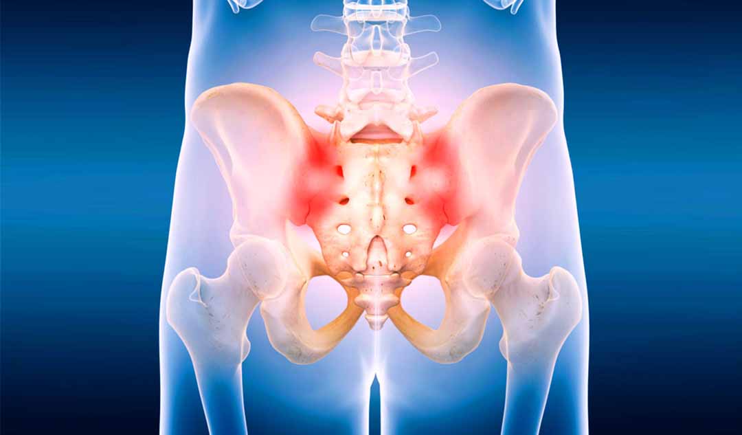 Làm thế nào tiêm các loại thuốc có thể ngăn được đau khớp cùng chậu (SI joint - sacroiliac joint)?