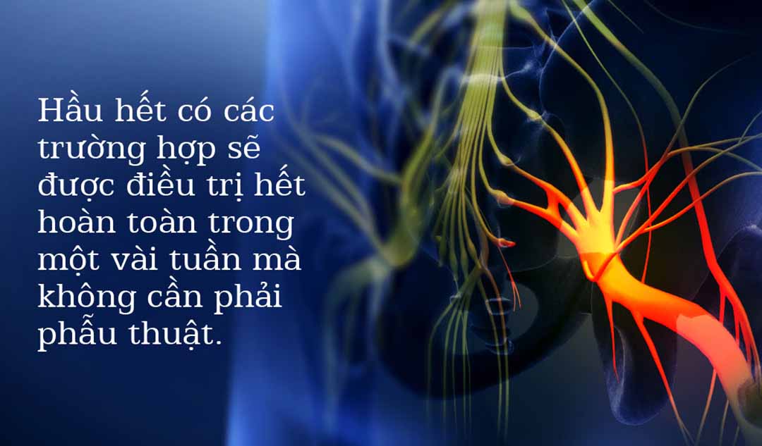 Nếu tôi được chẩn đoán bị đau thần kinh tọa, phương pháp điều trị của tôi sẽ là gì?