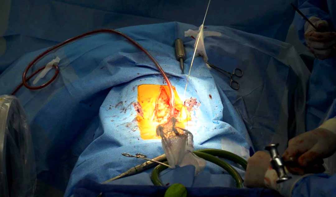 Phẫu thuật mở ống sống là gì?