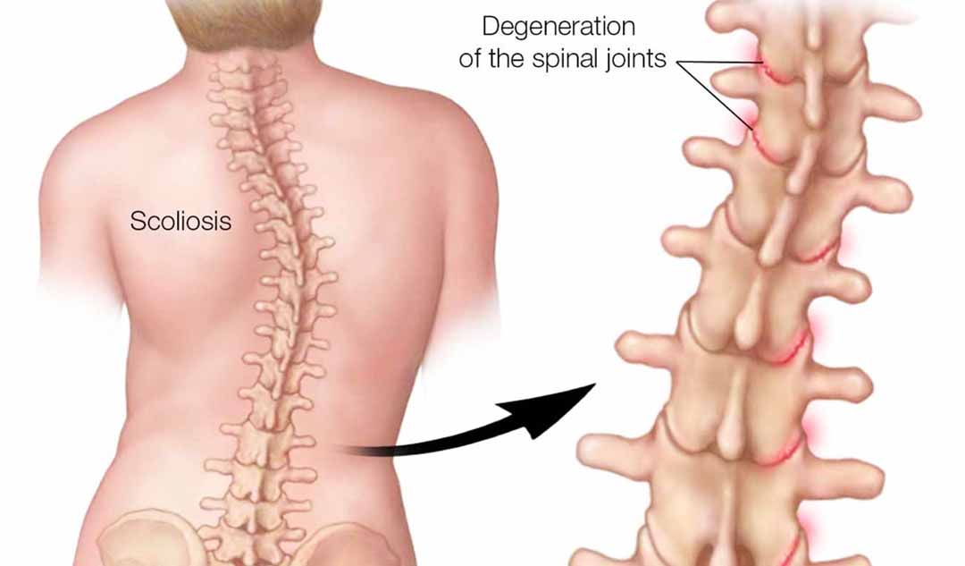 Vẹo cột sống bẩm sinh là gì?