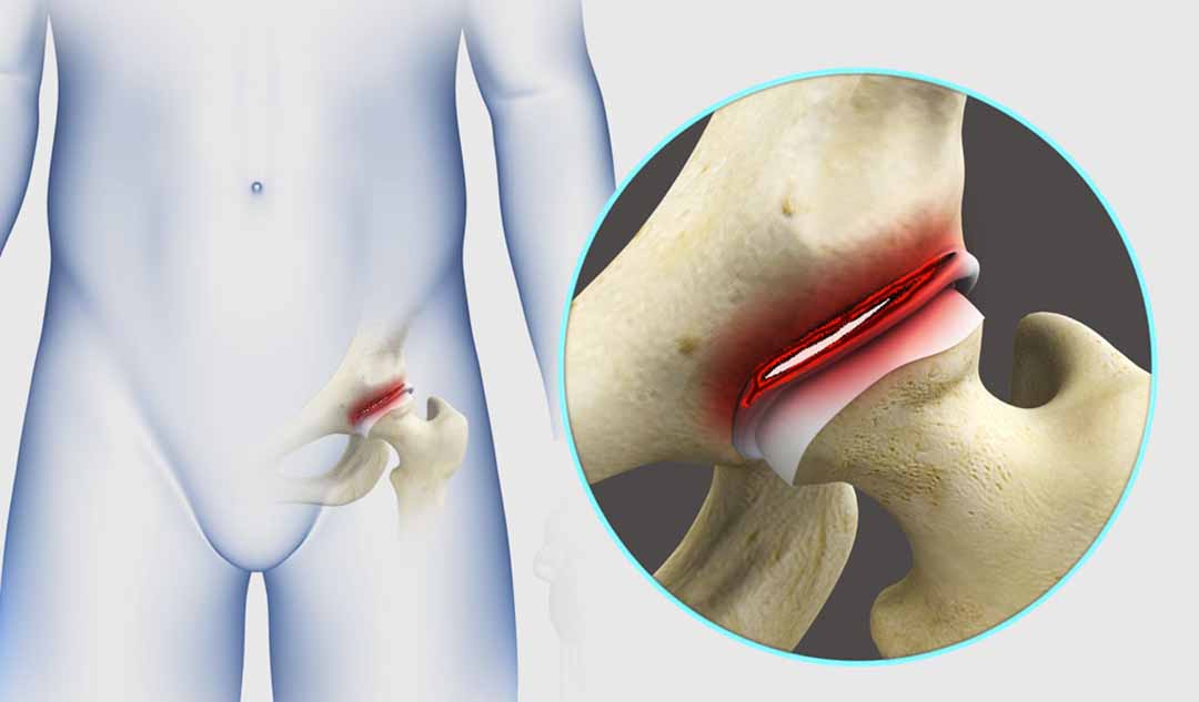 Tại sao khi rách môi gờ ở hông lại dẫn đến đau hông?