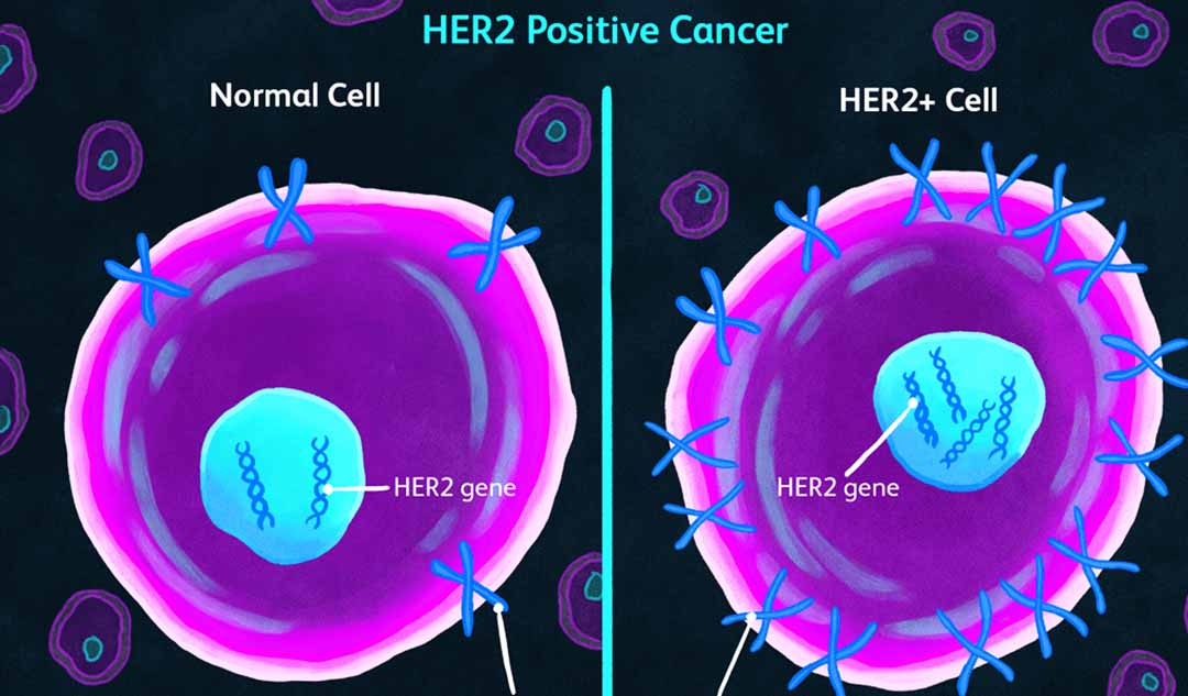 Bạn nên mong đợi về điều gì nếu bạn bị ung thư vú dương tính với HER2?