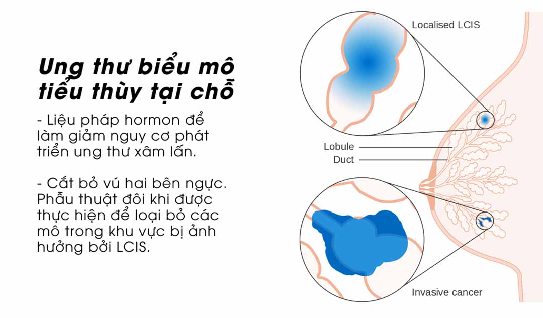 Các phương pháp điều trị điển hình cho ung thư biểu mô tiểu thùy tại chỗ trong ung thư vú là gì?