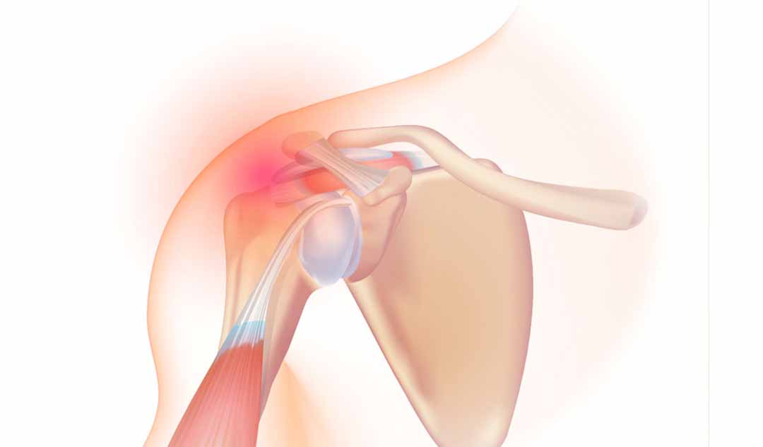 Làm thế nào bạn có thể ngăn ngừa hội chứng Rotator cuff?